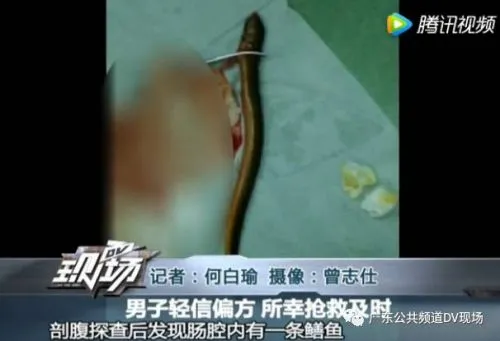广州男子听信偏方 用黄鳝塞肛门"通便"险丧命(图)